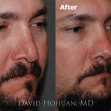 Diagnosis: Bilateral Cleft Nasal Deformity, Previous Rhinoplasty with Resultant Major Tip Deformity, Collapsed Tip Cartilage Left Greater Than Right, Severe Tip Asymmetry, Nasal Valve Collapse, Severe Septal Deformity.
Procedure: Revision Open Septorhinoplasty Using Rib Cartilage
Techniques: Rib cartilage harvest, Extended spreader grafts, triangular septal extension graft, alar rim grafts, onlay tip graft (cartilage), onlay tip graft (perichondrium), Lateral crural spanning sutures, medial crural fixation sutures.
Shown: Result at 18 months