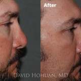 Diagnosis: Bilateral Cleft Nasal Deformity, Previous Rhinoplasty with Resultant Major Tip Deformity, Collapsed Tip Cartilage Left Greater Than Right, Severe Tip Asymmetry, Nasal Valve Collapse, Severe Septal Deformity.
Procedure: Revision Open Septorhinoplasty Using Rib Cartilage
Techniques: Rib cartilage harvest, Extended spreader grafts, triangular septal extension graft, alar rim grafts, onlay tip graft (cartilage), onlay tip graft (perichondrium), Lateral crural spanning sutures, medial crural fixation sutures.
Shown: Result at 18 months
