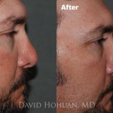 Diagnosis: Bilateral Cleft Nasal Deformity, Previous Rhinoplasty with Resultant Major Tip Deformity, Collapsed Tip Cartilage Left Greater Than Right, Severe Tip Asymmetry, Nasal Valve Collapse, Severe Septal Deformity.
Procedure: Revision Open Septorhinoplasty Using Rib Cartilage
Techniques: Rib cartilage harvest, Extended spreader grafts, triangular septal extension graft, alar rim grafts, onlay tip graft (cartilage), onlay tip graft (perichondrium), Lateral crural spanning sutures, medial crural fixation sutures.
Shown: Result at 18 months