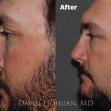 Diagnosis: Bilateral Cleft Nasal Deformity, Previous Rhinoplasty with Resultant Major Tip Deformity, Collapsed Tip Cartilage Left Greater Than Right, Severe Tip Asymmetry, Nasal Valve Collapse, Severe Septal Deformity.
Procedure: Revision Open Septorhinoplasty Using Rib Cartilage
Techniques: Rib cartilage harvest, Extended spreader grafts, triangular septal extension graft, alar rim grafts, onlay tip graft (cartilage), onlay tip graft (perichondrium), Lateral crural spanning sutures, medial crural fixation sutures.
Shown: Result at 18 months
