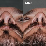 rhinoplasty-2018-19