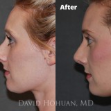 Diagnosis: Severe Nasal Obstruction, Aesthetic Deformity
Procedure: Open Structure Septorhinoplasty
Details: Precise Component Hump Reduction, Spreader Grafts, Tip Rhinoplasty using TIG, LCSS, DCS, TPS, and minimal cephalic reduction, crushed cartilage, alar rim grafts.