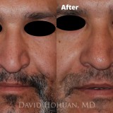 Diagnosis: Severe Nasal Obstruction, Ptosis (Droopy) Nasal Tip
Procedure: Open Structure Rhinoplasty
Details: Extended Spreader Grafts, Septal Extension Graft, Tip Suture Technique