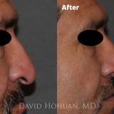 Diagnosis: Severe Nasal Obstruction, Ptosis (Droopy) Nasal Tip
Procedure: Open Structure Rhinoplasty
Details: Extended Spreader Grafts, Septal Extension Graft, Tip Suture Technique