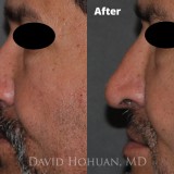 Diagnosis: Severe Nasal Obstruction, Ptosis (Droopy) Nasal Tip
Procedure: Open Structure Rhinoplasty
Details: Extended Spreader Grafts, Septal Extension Graft, Tip Suture Technique