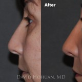 Procedure: Finesse Rhinoplasty
Technical Details: Closed Rhinoplasty, with Tip grafts, high-low osteotomies, component hump reduction, medial crural narrowing, tip rotation