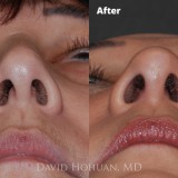 Procedure: Finesse Rhinoplasty
Technical Details: Closed Rhinoplasty, with Tip grafts, high-low osteotomies, component hump reduction, medial crural narrowing, tip rotation
