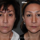 Procedure: Finesse Rhinoplasty
Technical Details: Closed Rhinoplasty, with Tip grafts, high-low osteotomies, component hump reduction, medial crural narrowing, tip rotation