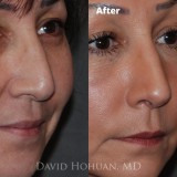 Procedure: Finesse Rhinoplasty
Technical Details: Closed Rhinoplasty, with Tip grafts, high-low osteotomies, component hump reduction, medial crural narrowing, tip rotation