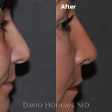 Procedure: Finesse Rhinoplasty
Technical Details: Closed Rhinoplasty, with Tip grafts, high-low osteotomies, component hump reduction, medial crural narrowing, tip rotation