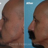 Diagnosis: Low Radix, Dorsal Hump
Procedure: Endonasal Septorhinoplasty (Closed Rhinoplasty)
Technique: Minimal Hump Reduction, Endonasal Septoplasty with Cartilage Harvest, Radix-Dorsal Cartilage Graft