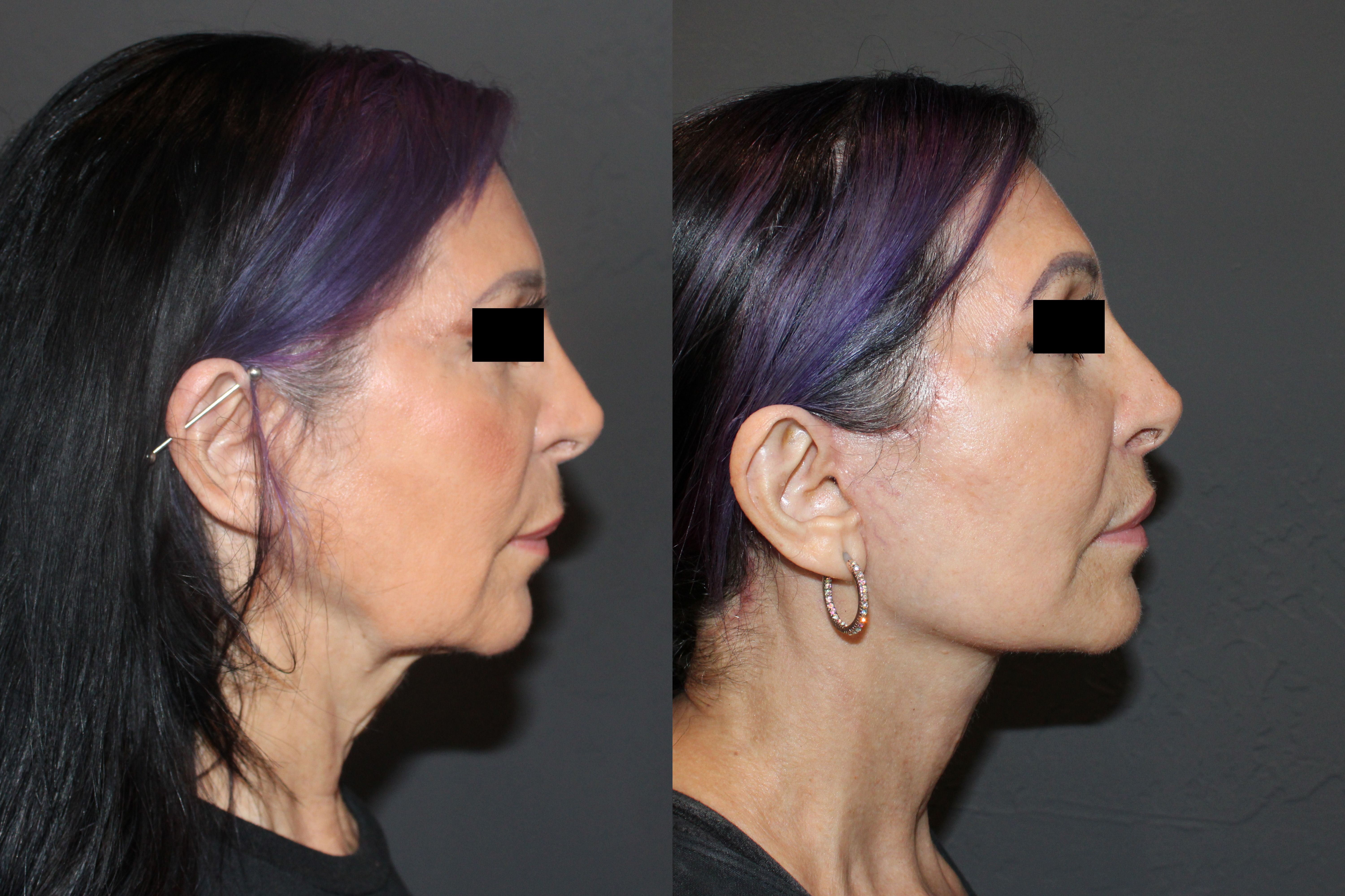 Facelift Lateral View 